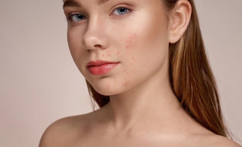 Model with acne breakouts on her cheek